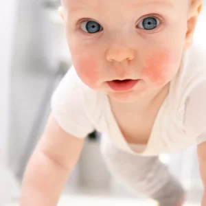 תדר סקאלרי של דר' רייף לבעיית אטופיק דרמטיטיס