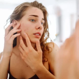 תדר סקאלרי של דר' רייף לבעיית אקנה