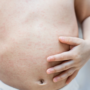 תדר קול סקאלרי של דוקטור רייף לפריחת חום בתינוקות